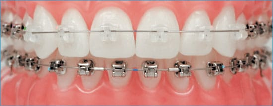 Choose-Typodont-Teeth