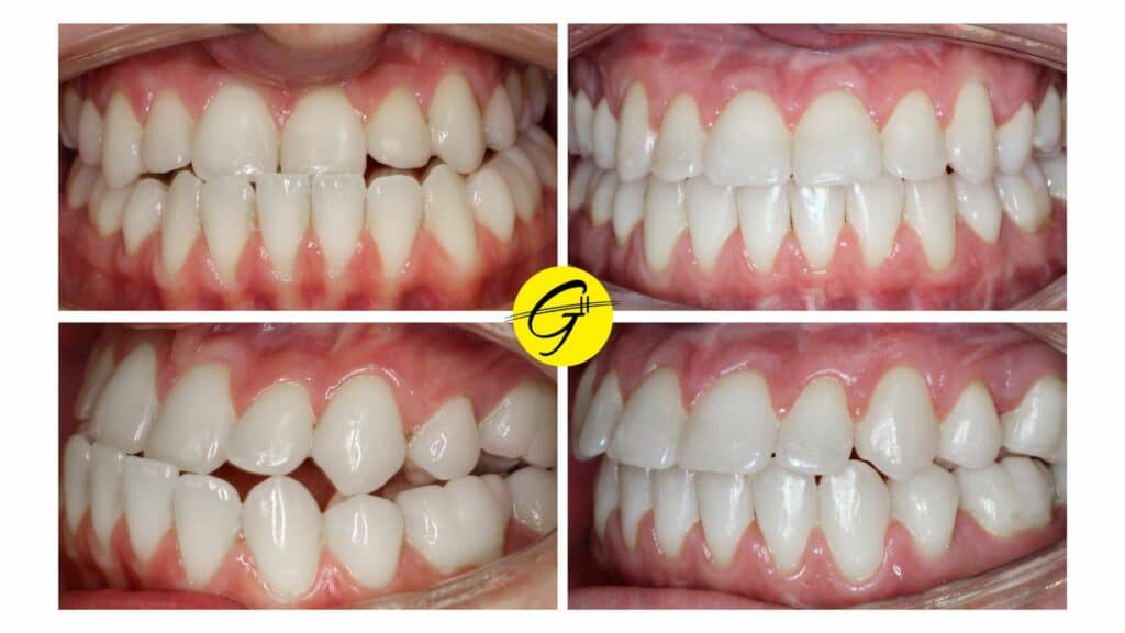 Close-up before and after intraoral photos showing straightened teeth and improved bite alignment from orthodontic treatment at Davoody & Hablinski Orthodontics in Houston, TX