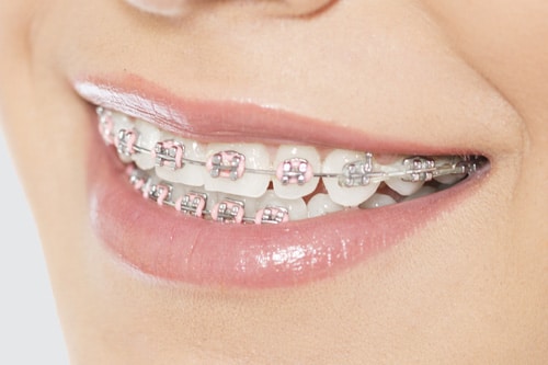 Metal Braces Davoody & Hablinski Orthodontics in Houston, TX