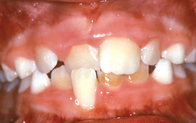 Crossbite Davoody & Hablinski Orthodontics in Houston, TX