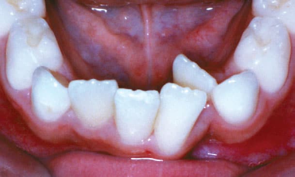 Crowding Davoody & Hablinski Orthodontics in Houston, TX