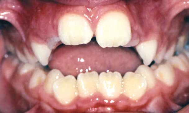 Open Bite Davoody & Hablinski Orthodontics in Houston, TX