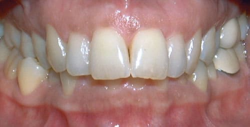 Overbite Davoody & Hablinski Orthodontics in Houston, TX
