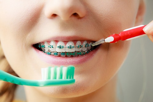 Caring for Braces Davoody & Hablinski Orthodontics in Houston, TX