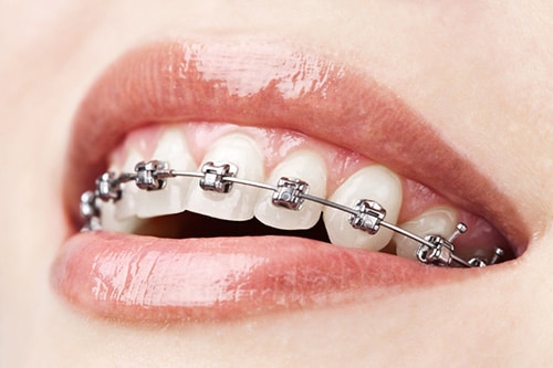 Damon Braces Davoody & Hablinski Orthodontics in Houston, TX