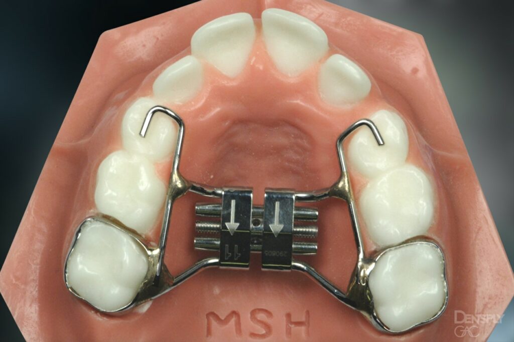 Palate Exapander MSH Davoody & Hablinski Orthodontics in Houston, TX