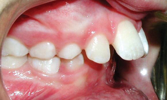 Protrusion Davoody & Hablinski Orthodontics in Houston, TX