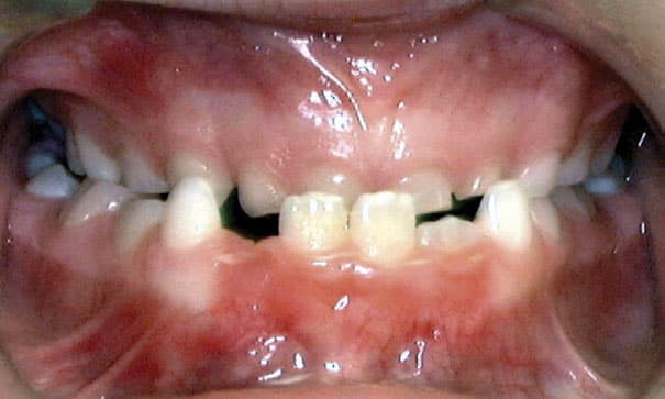 Underbite Davoody & Hablinski Orthodontics in Houston, TX