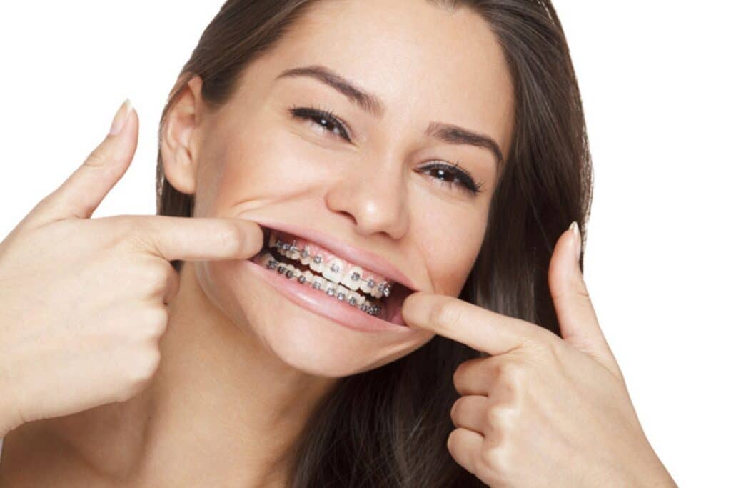 What Happens in the First 90 Days of Braces in Houston, TX? Davoody and Hablinski Orthodontics